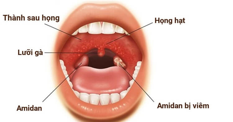 viem-hong-hat-xay-ra-do-he-mien-dich-khong-chong-choi-duoc-voi-vi-khuan