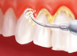 HybdSU20B-nhung-mang-bam-lau-ngay-gay-mat-tham-my